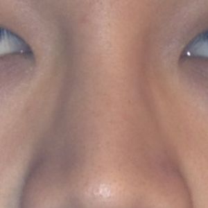 Chỉnh sửa trụ mũi co rút và đầu mũi thấp