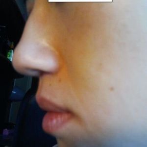 Mũi “củ hành” của tôi có thể chỉnh sửa được bằng phương pháp mổ kín không?