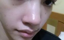 Tôi có thể nâng mũi mà chỉ dùng sụn tai và sụn vách ngăn không?