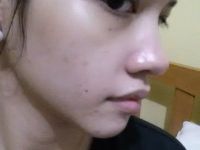 Tôi có thể nâng mũi mà chỉ dùng sụn tai và sụn vách ngăn không? Tôi có thể nâng mũi mà chỉ dùng sụn tai và sụn vách ngăn không?