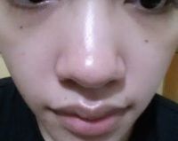 Tôi có thể nâng mũi mà chỉ dùng sụn tai và sụn vách ngăn không? Tôi có thể nâng mũi mà chỉ dùng sụn tai và sụn vách ngăn không?