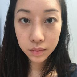 Gốc mũi quá cao sau khi nâng mũi bằng silicone