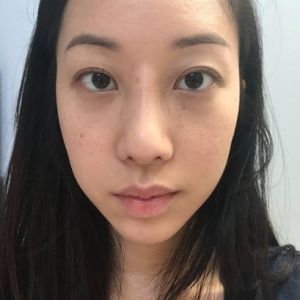 Gốc mũi quá cao sau khi nâng mũi bằng silicone