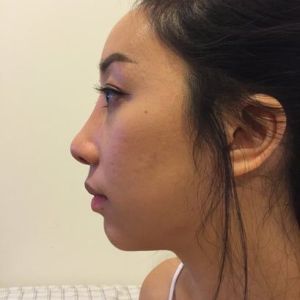 Gốc mũi quá cao sau khi nâng mũi bằng silicone