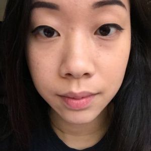 Gốc mũi quá cao sau khi nâng mũi bằng silicone