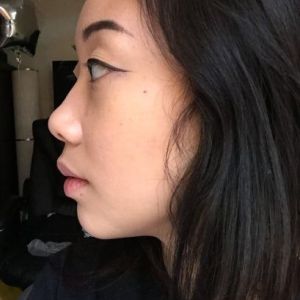 Gốc mũi quá cao sau khi nâng mũi bằng silicone