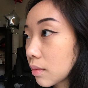 Gốc mũi quá cao sau khi nâng mũi bằng silicone