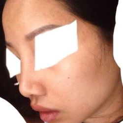 Sụn tai nâng mũi sẽ bị hấp thụ đi bao nhiêu?