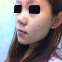 Mũi hếch, đầu mũi to, phải làm gì? Mũi hếch, đầu mũi to, phải làm gì?