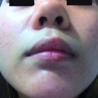 Mũi hếch, đầu mũi to, phải làm gì? Mũi hếch, đầu mũi to, phải làm gì?