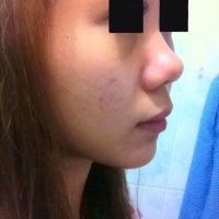 Mũi hếch, đầu mũi to, phải làm gì? Mũi hếch, đầu mũi to, phải làm gì?