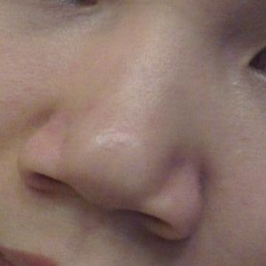 Đầu mũi bị bè, hai bên lỗ mũi rộng: Liệu phẫu thuật thu gọn cánh mũi có thể khắc phục được không?