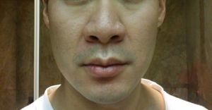 Thu gọn cánh mũi có đủ để chỉnh sửa mũi to, mũi củ hành ở nam giới không?