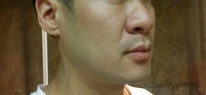 Thu gọn cánh mũi có đủ để chỉnh sửa mũi to, mũi củ hành ở nam giới không?