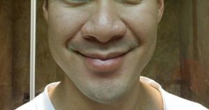 Thu gọn cánh mũi có đủ để chỉnh sửa mũi to, mũi củ hành ở nam giới không?