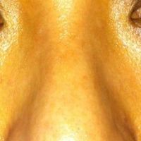 Bị sưng nặng sau 3,5 tháng làm mũi: tiêm steroid có giúp giảm sưng không? Bị sưng nặng sau 3,5 tháng làm mũi: tiêm steroid có giúp giảm sưng không?
