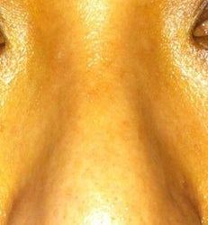 Bị sưng nặng sau 3,5 tháng làm mũi: tiêm steroid có giúp giảm sưng không?