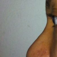Bị sưng nặng sau 3,5 tháng làm mũi: tiêm steroid có giúp giảm sưng không? Bị sưng nặng sau 3,5 tháng làm mũi: tiêm steroid có giúp giảm sưng không?