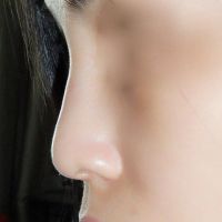 Có nên tiêm tan Juvederm trước khi nâng mũi không?