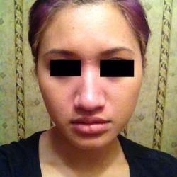 Nâng mũi kết hợp độn cằm có giúp khuôn mặt tôi hài hòa hơn không?