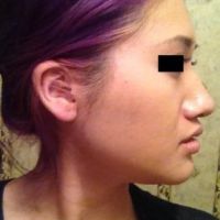 Nâng mũi kết hợp độn cằm có giúp khuôn mặt tôi hài hòa hơn không?