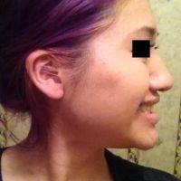 Nâng mũi kết hợp độn cằm có giúp khuôn mặt tôi hài hòa hơn không?