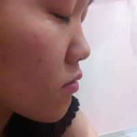 Trường hợp của tôi nên dùng sụn sườn hay sụn nhân tạo?