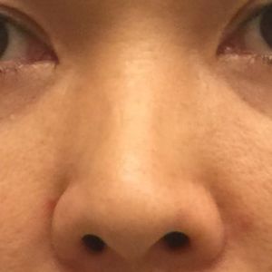 5 tháng sau phẫu thuật nâng mũi bằng sụn sườn: không hài lòng vì đầu mũi quá dài