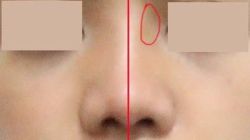 Goretex bị lệch, dịch chuyển sau 2 tháng nâng mũi?