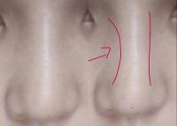 Sụn nâng mũi có thể dịch chuyển không? Sụn nâng mũi có thể dịch chuyển không?