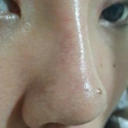 Vỡ mao mạch mũi 3 tuần sau nâng mũi: liệu có tự hết không?