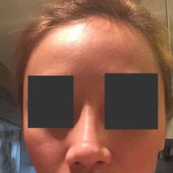 Tạo khấc đầu mũi sau phẫu thuật nâng mũi: nguyên nhân vì sao?