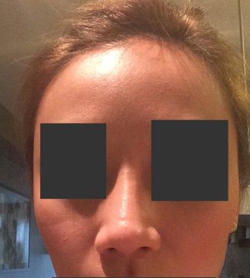 Tạo khấc đầu mũi sau phẫu thuật nâng mũi: nguyên nhân vì sao?