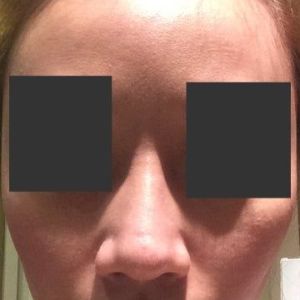 Tạo khấc đầu mũi sau phẫu thuật nâng mũi: nguyên nhân vì sao?