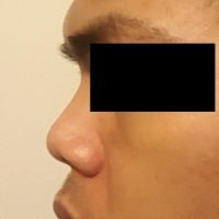 Lựa chọn tốt nhất cho mũi ngắn, hếch của tôi?