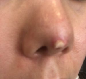 Lòi sụn ở đầu mũi sau phẫu thuật 5 tháng