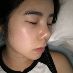 Sau nâng mũi: mũi càng ngày càng bị dịch chuyển, hếch lên phía trên