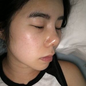 Sau nâng mũi: mũi càng ngày càng bị dịch chuyển, hếch lên phía trên