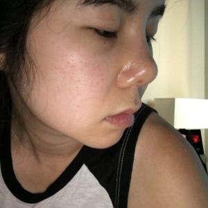 Sau nâng mũi: mũi càng ngày càng bị dịch chuyển, hếch lên phía trên