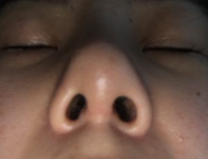 Sau nâng mũi: mũi càng ngày càng bị dịch chuyển, hếch lên phía trên