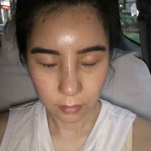 Sau nâng mũi: mũi càng ngày càng bị dịch chuyển, hếch lên phía trên