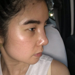 Sau nâng mũi: mũi càng ngày càng bị dịch chuyển, hếch lên phía trên