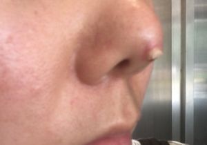 Lòi sụn ở đầu mũi sau phẫu thuật 5 tháng
