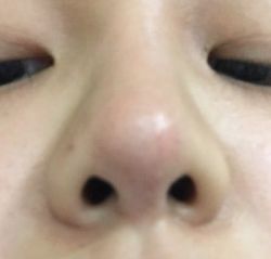 Đầu mũi sưng u lên: liệu sụn tai có bị đùn lòi ra không?