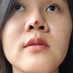 Đầu mũi bị đỏ, chảy mủ, có phải nhiễm trùng hay dấu hiệu đùn sụn, lòi sụn?