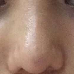 Liệu sụn sườn có tồn tại vĩnh viễn trong mũi không?