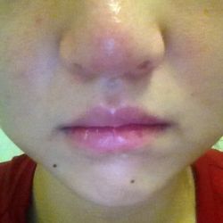 Sụn nâng mũi hình chữ L có dễ bị di lệch sau khi mũi bị va đập không?