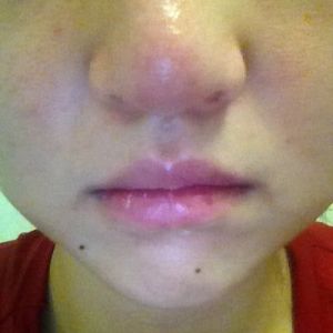 Sụn nâng mũi hình chữ L có dễ bị di lệch sau khi mũi bị va đập không?