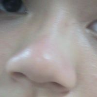 Làm sao để lỗ mũi nhỏ hơn? Làm sao để lỗ mũi nhỏ hơn?