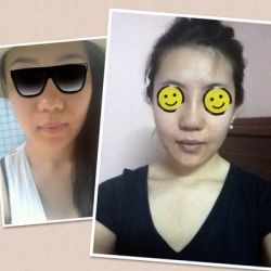 10 ngày sau phẫu thuật: liệu đầu mũi có thon gọn hơn được nữa không?